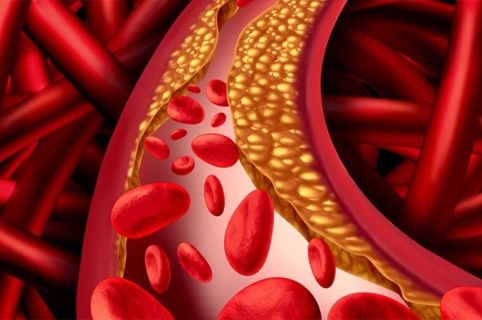 Peripheral arterial disease