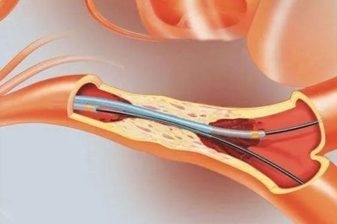 Tumor Vascular Intervention